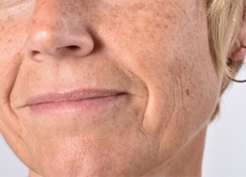 Photo of hyperpigmentation on a woman's face