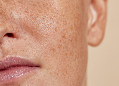 Photo of freckles and large pores on a person's face