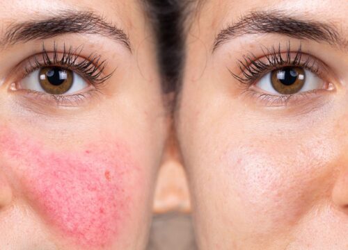 Photo of a woman's face with rosacea and without it