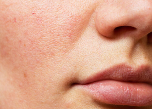 Photo of vascular lesions on a woman's face