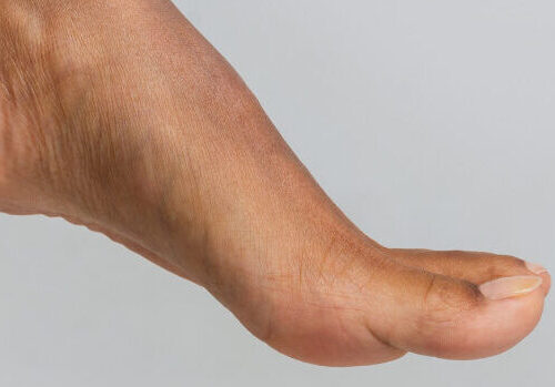 Photo of a woman's foot