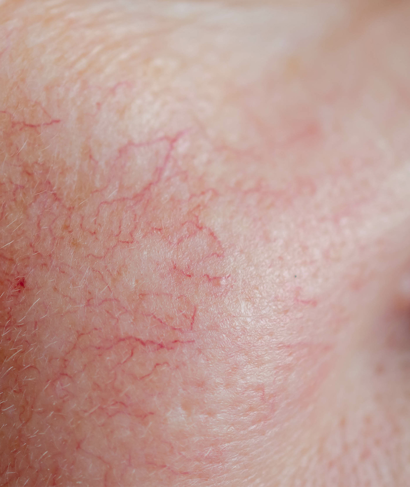 Photo of spider veins on a woman's face
