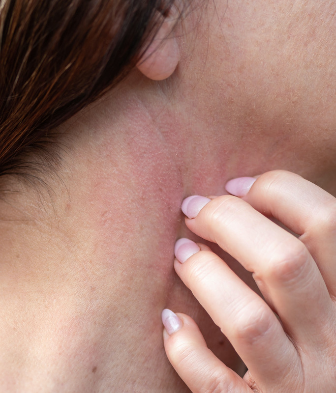 Poikiloderma on a woman's neck