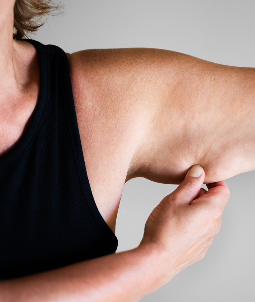 Photo of a woman tugging on loose skin on her arm
