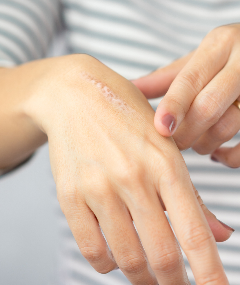 Photo of scars on a woman's hand