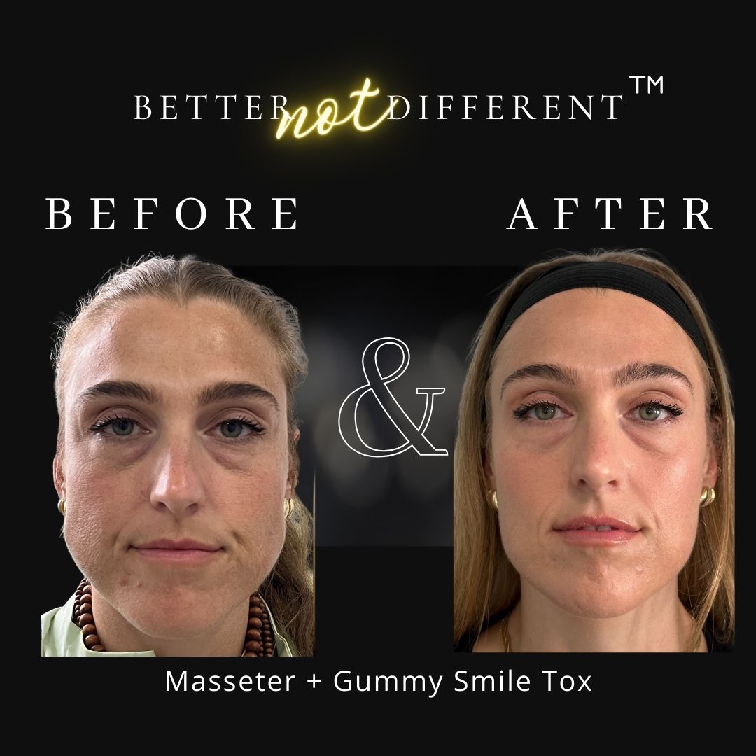 Before and after Botox results