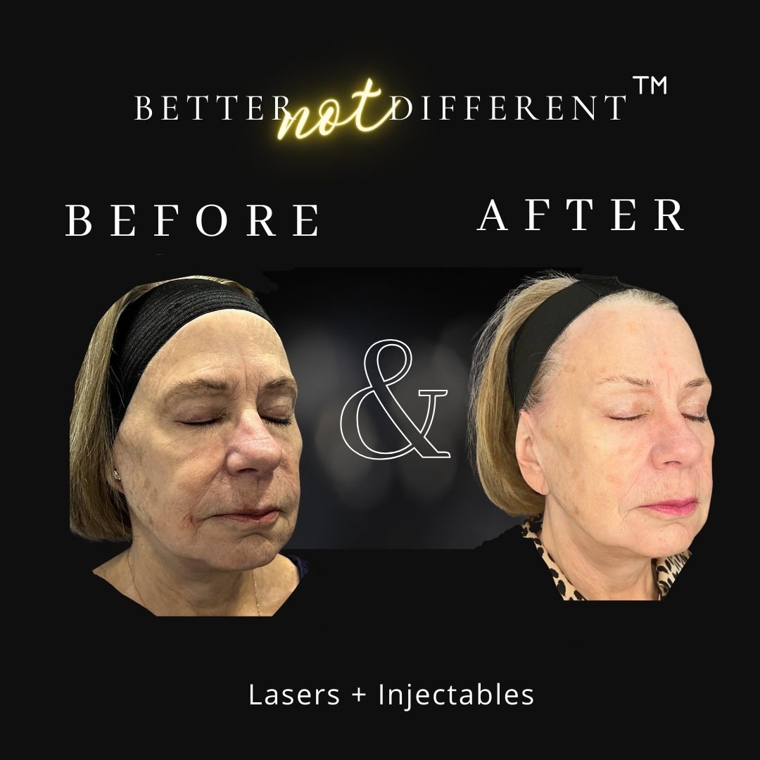 Before and after results for Laser and Injectables combination treatments