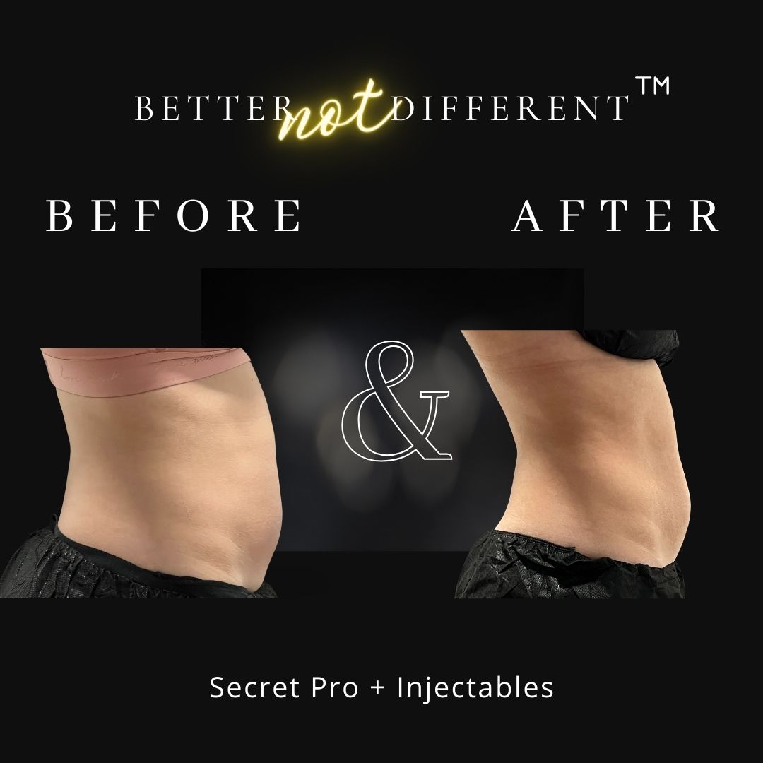 Before and after results for Secret Pro and Injectables combination treatments