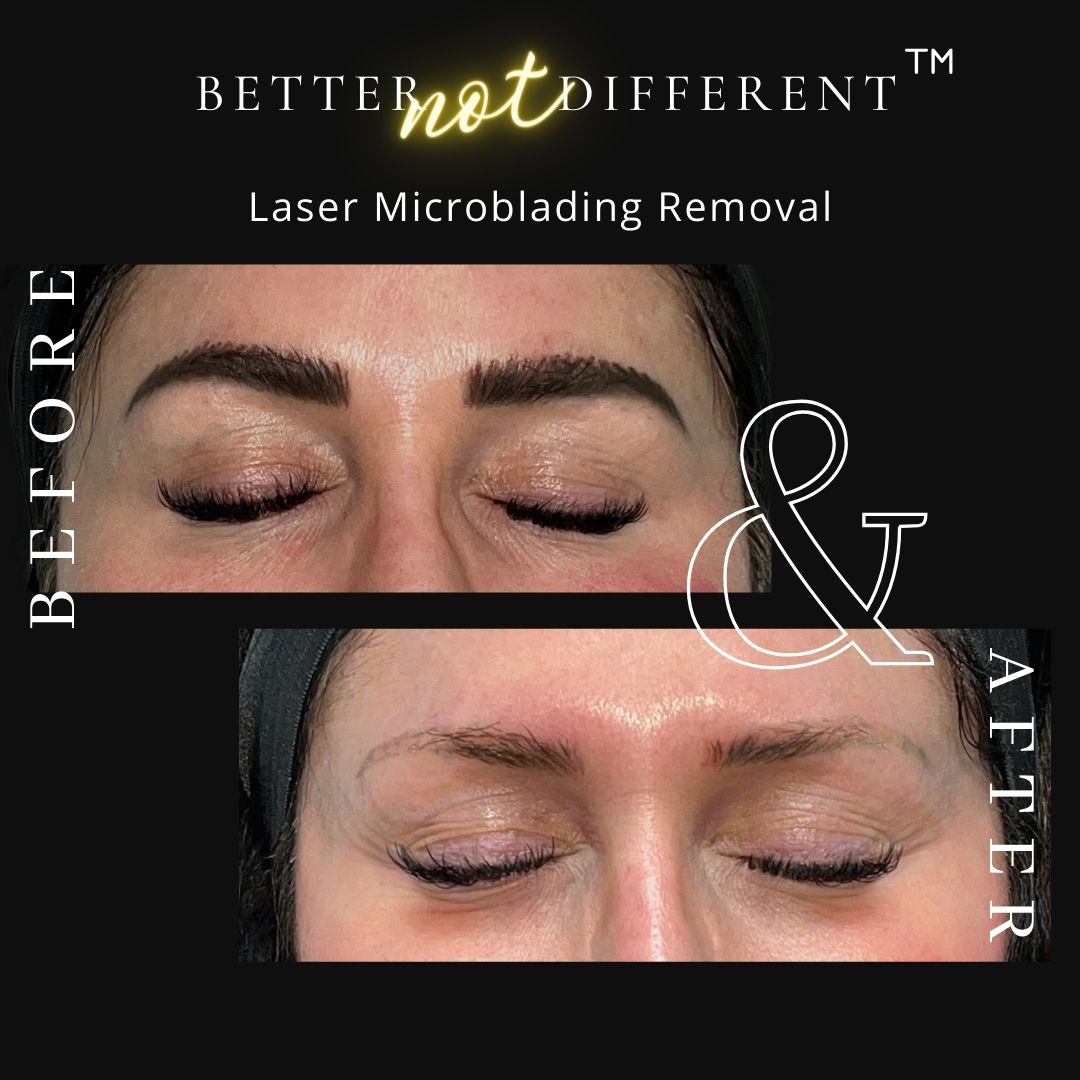 Before and after laser microblading tattoo removal