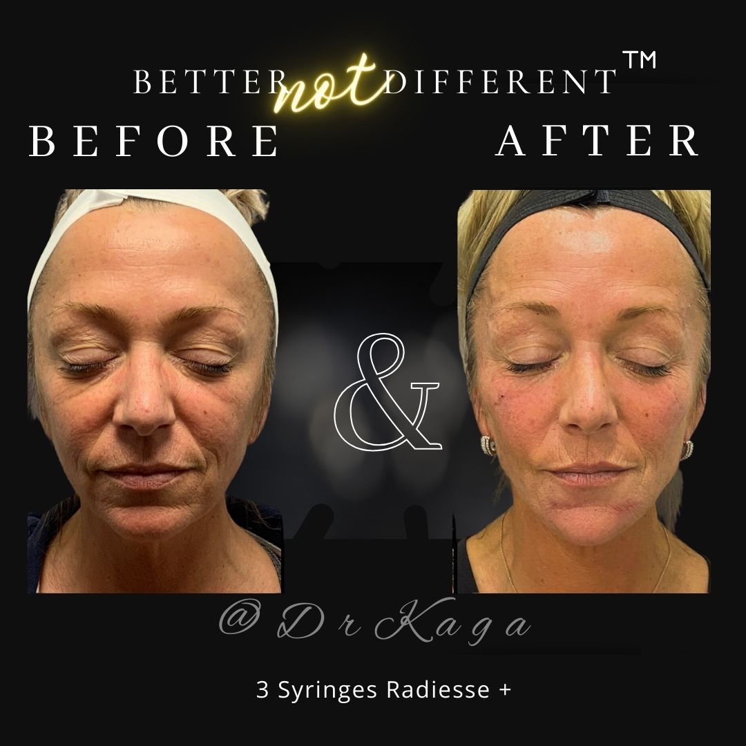 Before and after dermal filler results with Radiesse