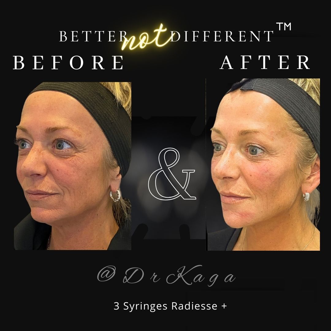Before and after dermal filler results with Radiesse