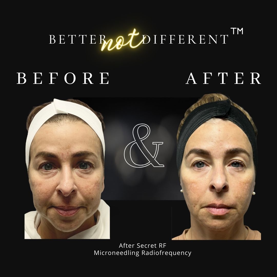 Before and after Secret™ RF microneedling results
