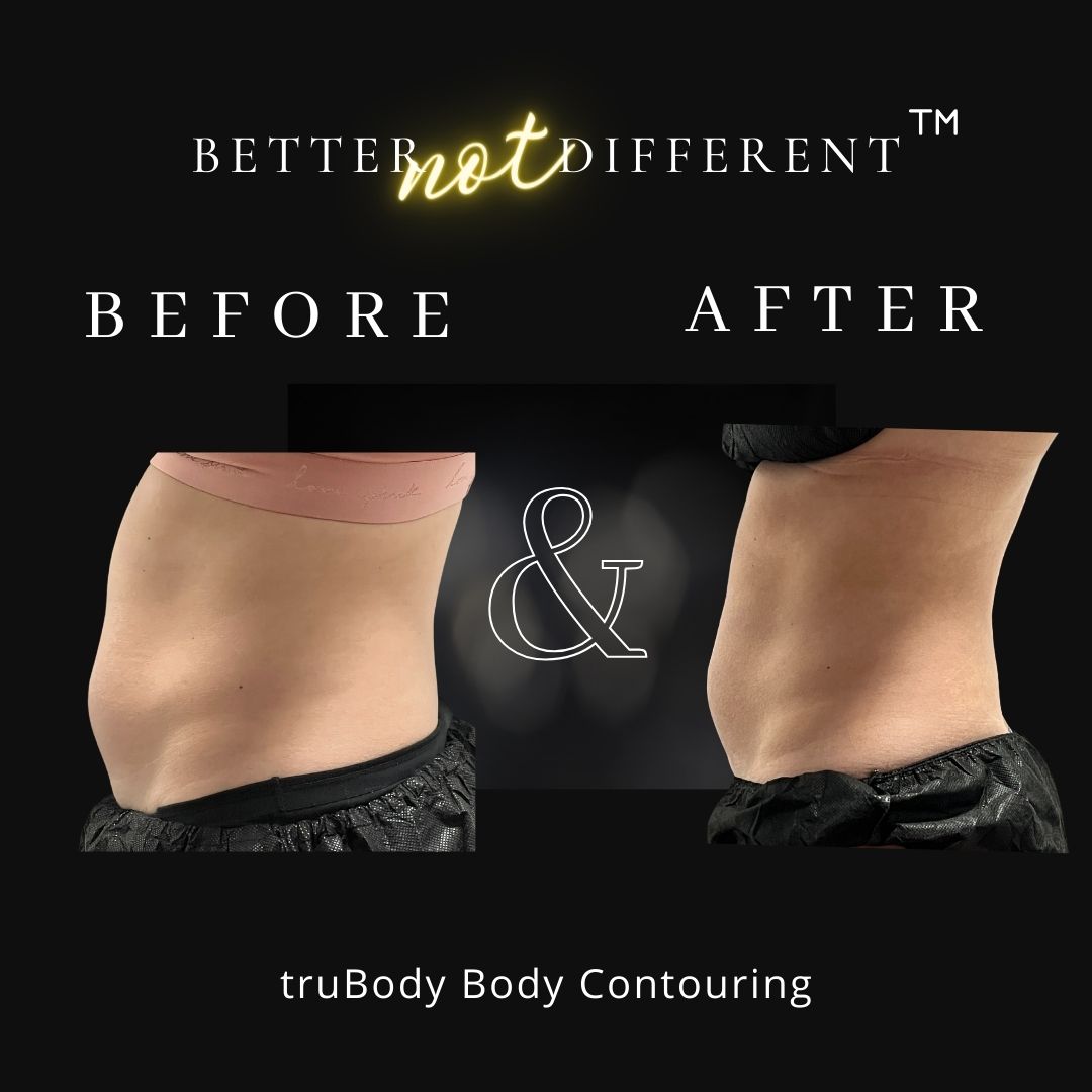 Before and after Trubody fat reduction results