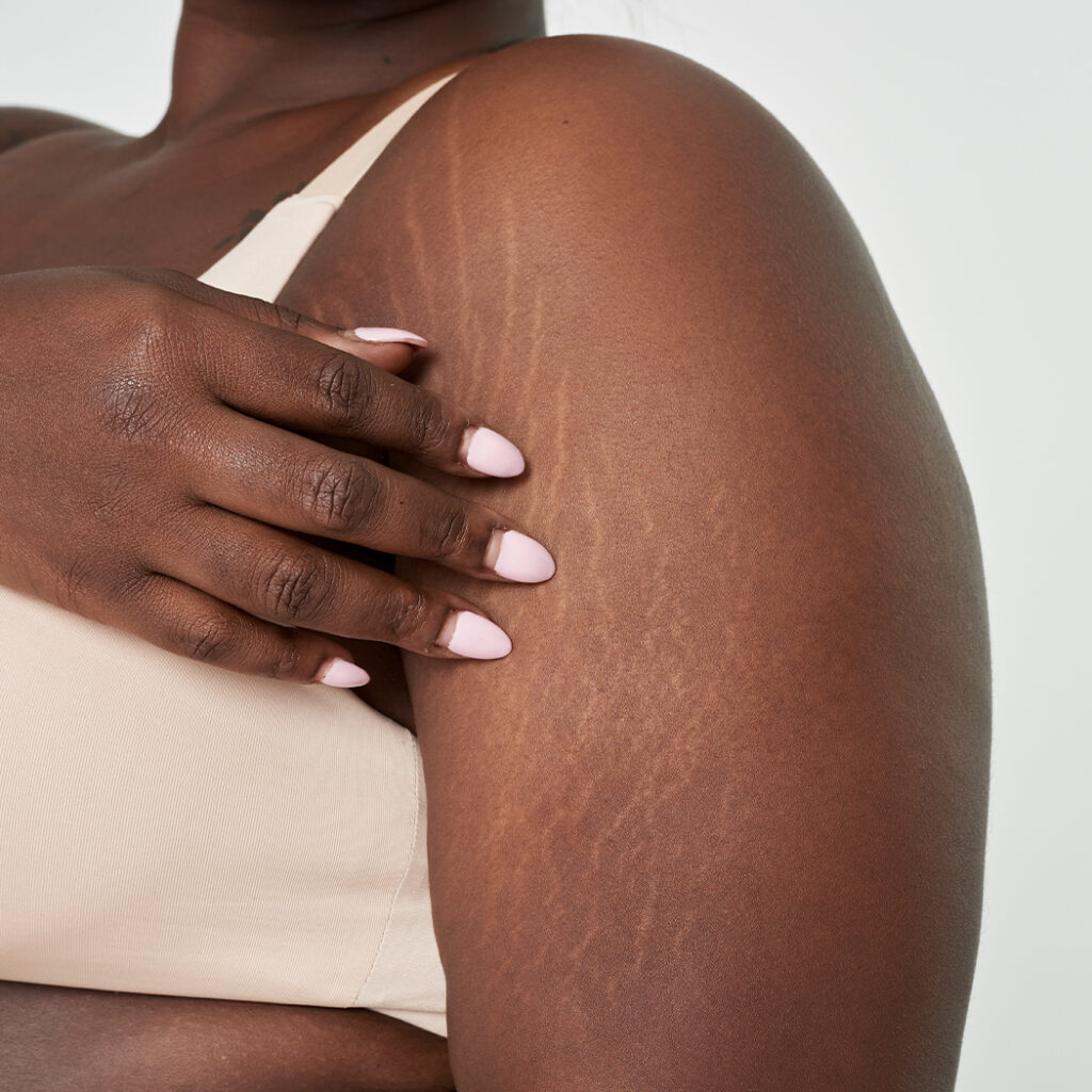 Photo of stretch marks on a woman's arm