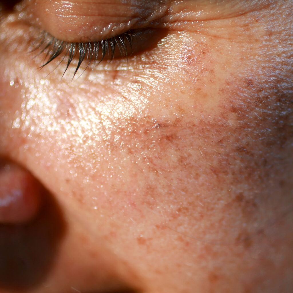 Close-up photo of age spots on a woman's face