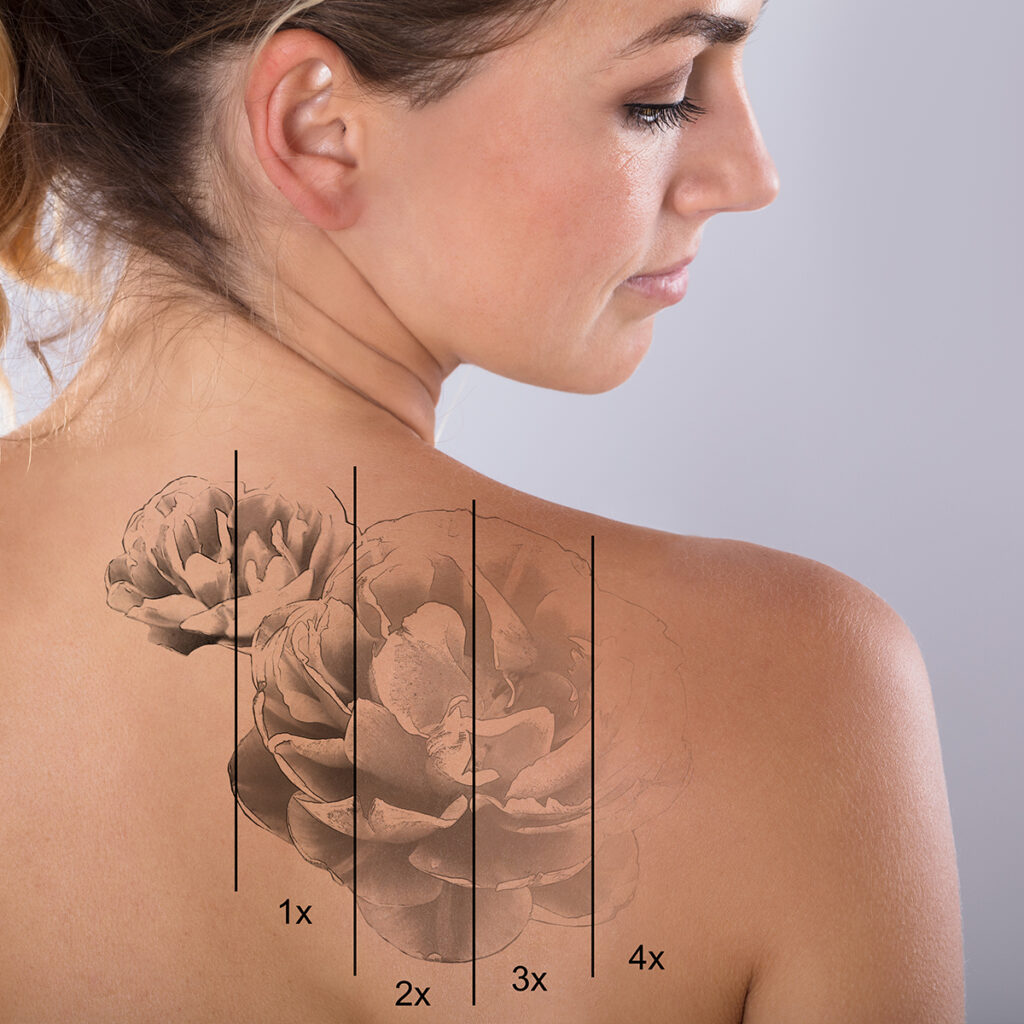 Photo of tattoo removal on a woman's back