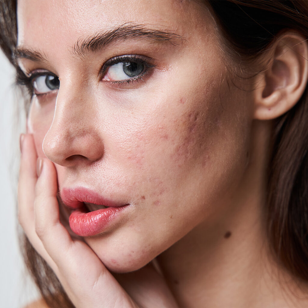 Photo of a woman with acne scars on her face