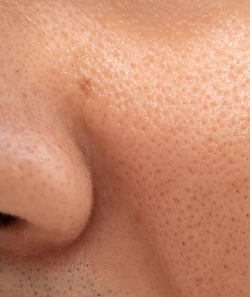 Photo of large pores on a man's face