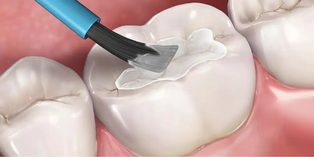 Photo of a dental sealant being applied to a tooth