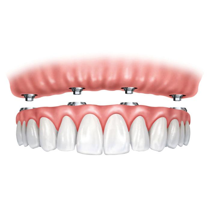 Drawn photo of implant-supported dentures