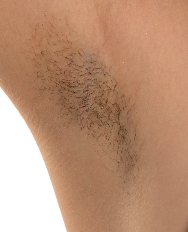 Photo of unwanted hair on a woman's armpit