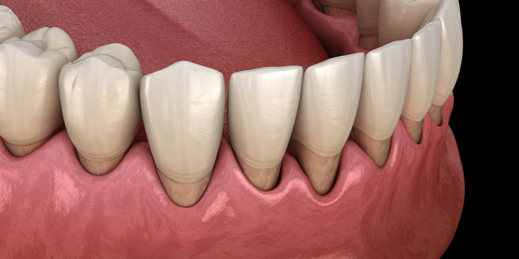Photo of periodontal disease