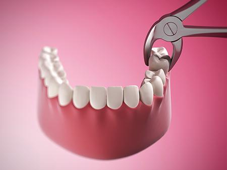 Image of a tooth extraction