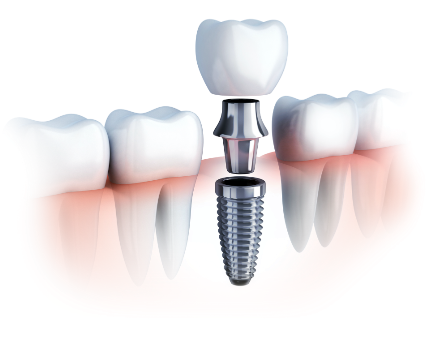 Computer generated graphic of a dental implant