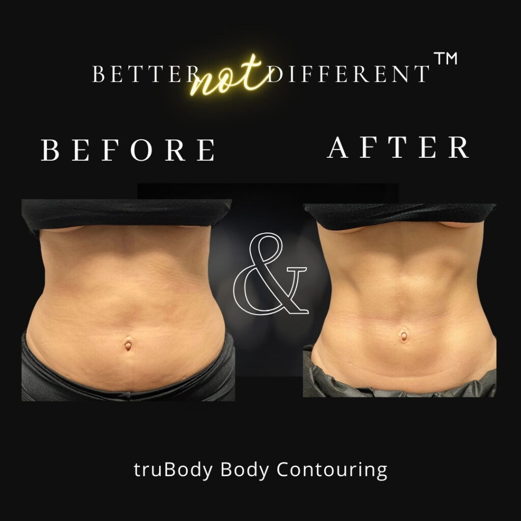 Before and after body sculpting results