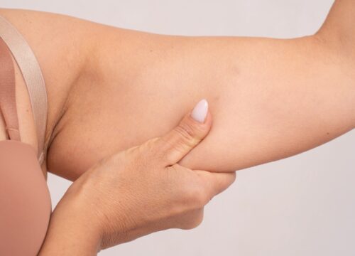 Realistic close-up of woman's arm with visible skin laxity.